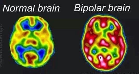 Bipolar disorder brain scans differences